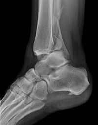 Stress Fractures | Great Midwest Foot and Ankle Centers